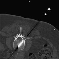 Abbildung 1: Vertebroplastie - Wirbelkörperpunktion