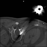 Abbildung 2: Vertebroplastie - Wirbelkörperpunktion