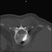 Abbildung 3: Vertebroplastie - Wirbelkörperpunktion