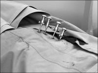 Abbildung 5: Vertebroplastie - Mehretagenbehandlung