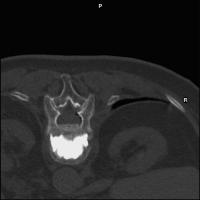 Abbildung 6: Vertebroplastie
