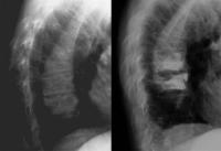 Abbildung 7: Vertebroplastie