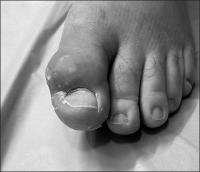 Abbildung 1: Kristallarthropathie - Tophöse Gicht