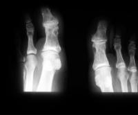 Abbildung 2: Kristallarthropathie - Tophöse Gicht