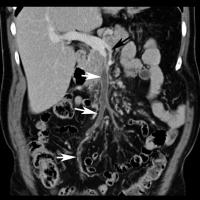 Abbildung 1: Mesenterialvenenthrombose
