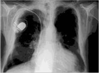 Abbildung 2: Biventrikulärer Herzschrittmacher