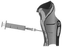 Abbildung 1: Perkutane Dilatationstracheotomie