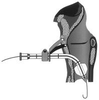 Abbildung 4: Perkutane Dilatationstracheotomie