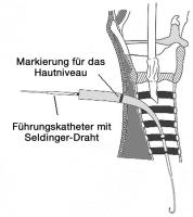 Abbildung 5: Perkutane Dilatationstracheotomie