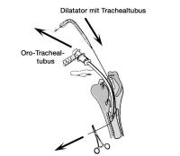 Abbildung 6: Perkutane Dilatationstracheotomie