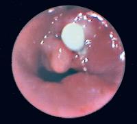 Abbildung 7: Trachea - Stenose