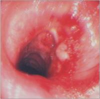 Abbildung 9: Trachea - Stenose - Lasertherapie