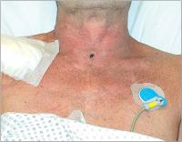 Abbildung 10: Perkutane Dilatationstracheotomie