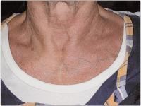 Abbildung 11: Perkutane Dilatationstracheotomie