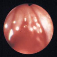 Abbildung 12: Stimmbänder - Schleimhautläsion