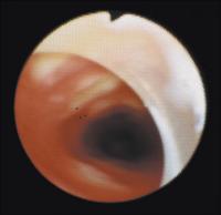Abbildung 13: Trachea - Schleimhautläsion