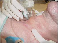 Abbildung 15: Perkutane Tracheotomie - Trachealkanüle