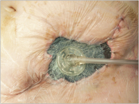 Abbildung 2: V.A.C.-Therapie