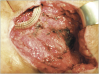 Abbildung 3: Prothese