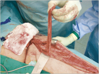 Abbildung 4: Muskellappen