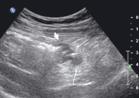 Abbildung 2: Divertikulitis