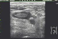 Abbildung 3: Divertikulitis - Peridivertikulitis