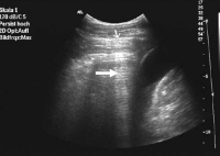 Abbildung 5: Reverberationsecho