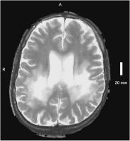 Abbildung 1: Adrenomyeloneuropathie
