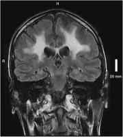 Abbildung 2: Adrenomyeloneuropathie