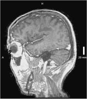 Abbildung 3: Adrenomyeloneuropathie
