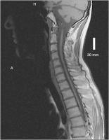 Abbildung 4: Adrenomyeloneuropathie
