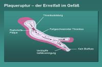Abbildung 26: Plaqueruptur – der Ernstfall im Gefäß