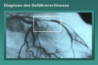 Abbildung 28: Diagnose des Gefäßverschlusses