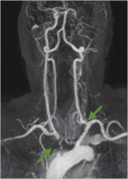 Abbildung 1: MR-Angiographie