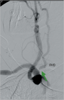 Abbildung 10: Subtraktionsangiographie