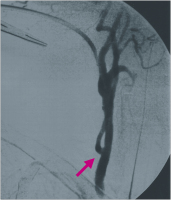 Abbildung 12: Kontrollangiographie