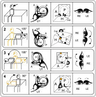 Abbildung 41-4: BPPV