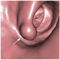 Abbildung 1a: Koloskopie