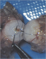 Abbildung 2: Vasovasostomie