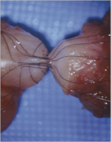 Abbildung 3: Vasovasostomie