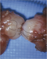 Abbildung 4: Vasovasostomie