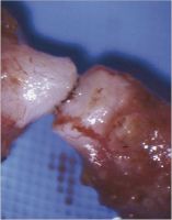 Abbildung 5: Vasovasostomie