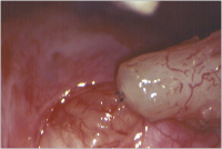 Abbildung 7: Tubulovasostomie