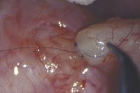 Abbildung 8: Tubulovasostomie