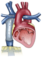 Abbildung 1: Fontanoperation