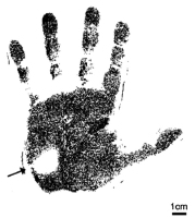 Abbildung 1: Palmare Hyperhidrose