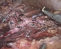 Abbildung 1: Lymphknotendissektion