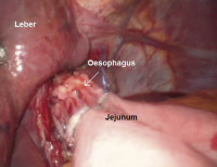 Abbildung 2: Anastomose