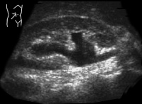 Abbildung 2: Nierendilatation