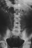 Abbildung 4: Pigtail-Katheter